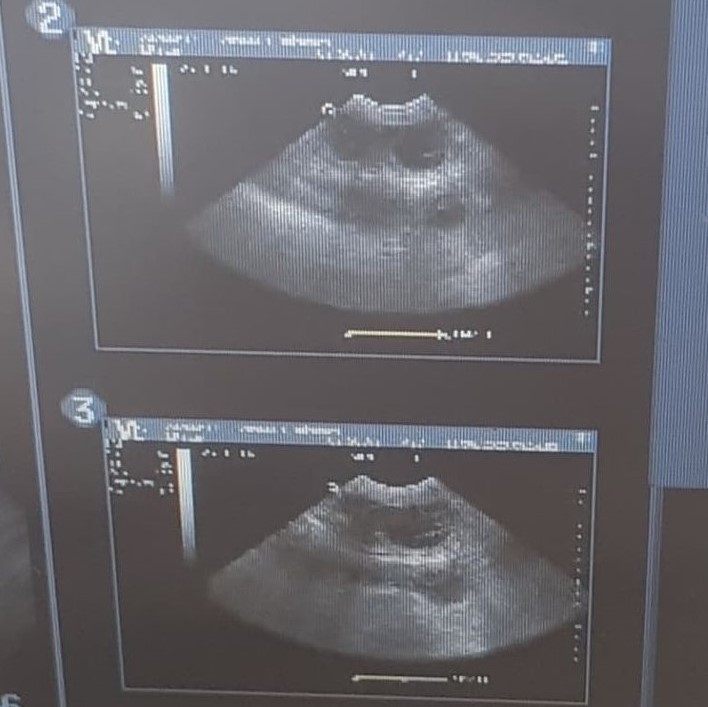 ultrasound